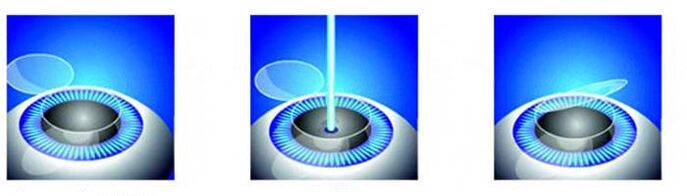 The level of laser vision correction