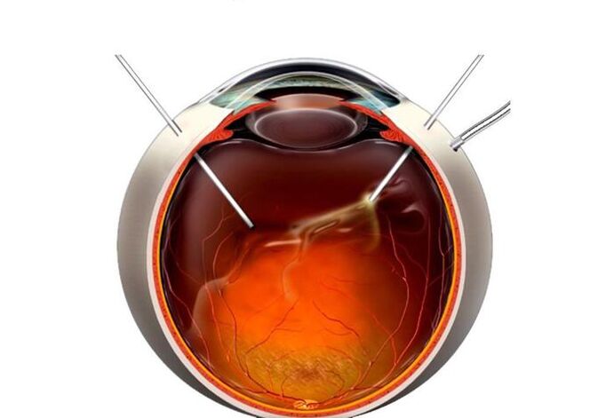 Vitrectomy - operation to restore sight